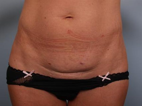 Tummy Tuck Gallery - Patient 1311065 - Image 9