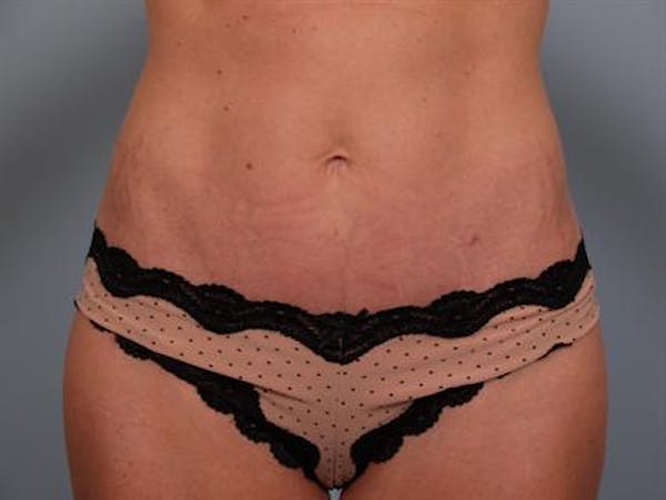 Tummy Tuck Before & After Gallery - Patient 1311065 - Image 10