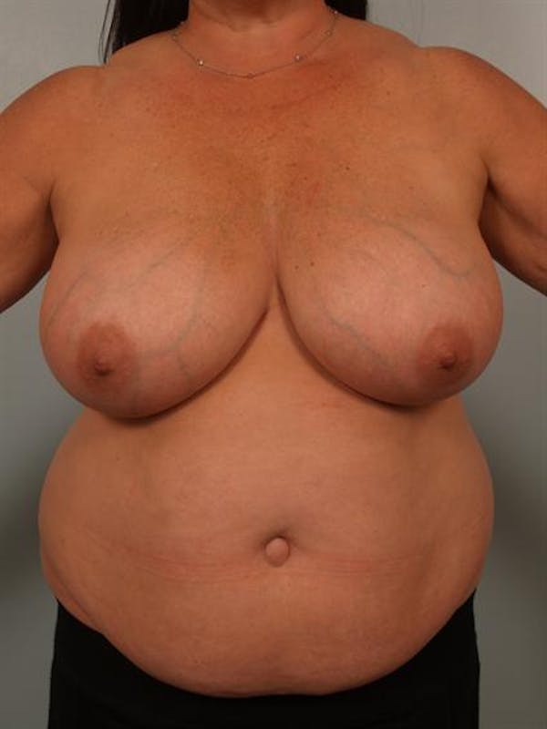 Power Assisted Liposuction Before & After Gallery - Patient 1311067 - Image 3