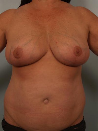Power Assisted Liposuction Before & After Gallery - Patient 1311067 - Image 4