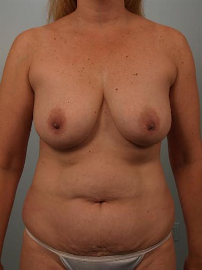 Power Assisted Liposuction Before & After Gallery - Patient 1311069 - Image 1
