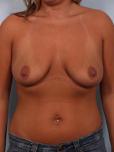 Breast Lift Before & After Gallery - Patient 1311070 - Image 1