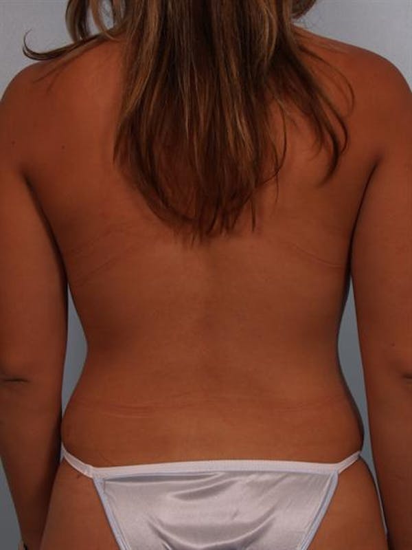Tummy Tuck Before & After Gallery - Patient 1311068 - Image 8