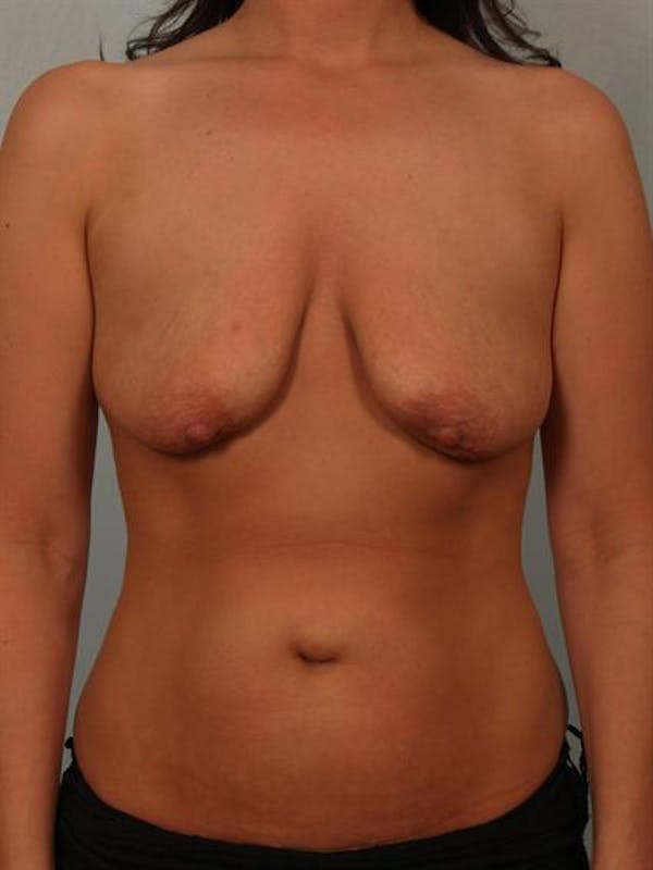 Breast Lift Gallery - Patient 1311073 - Image 1