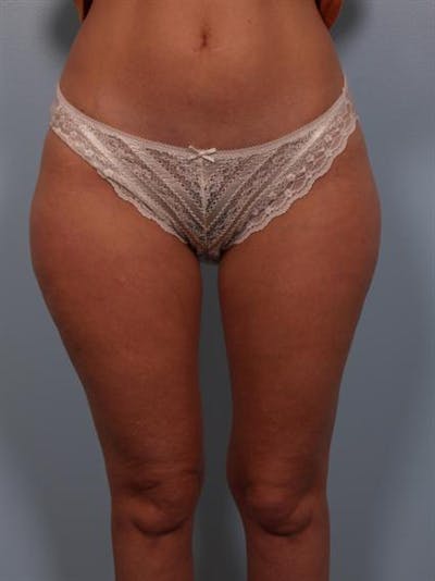 Power Assisted Liposuction Before & After Gallery - Patient 1311075 - Image 1