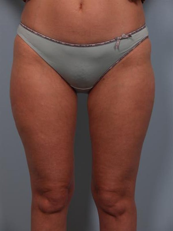 Power Assisted Liposuction Before & After Gallery - Patient 1311075 - Image 2