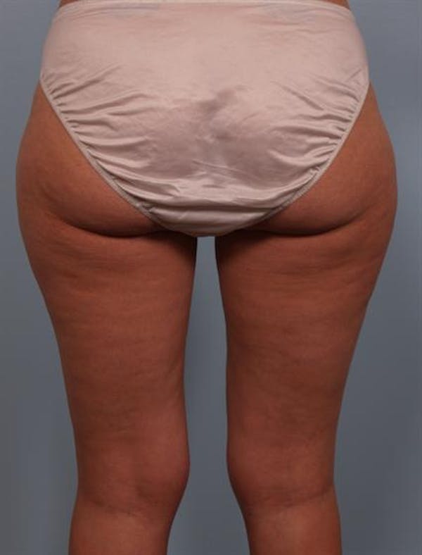 Power Assisted Liposuction Before & After Gallery - Patient 1311075 - Image 3