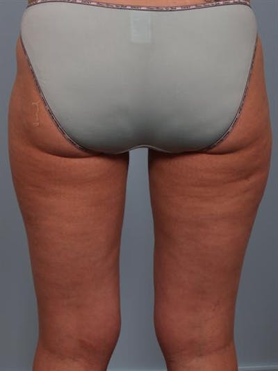 Power Assisted Liposuction Before & After Gallery - Patient 1311075 - Image 4
