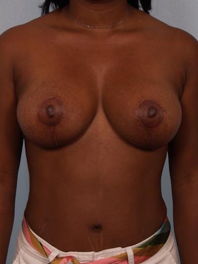 Breast Lift Gallery - Patient 1311077 - Image 2