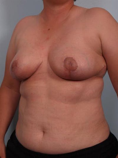 Power Assisted Liposuction Before & After Gallery - Patient 1311078 - Image 4