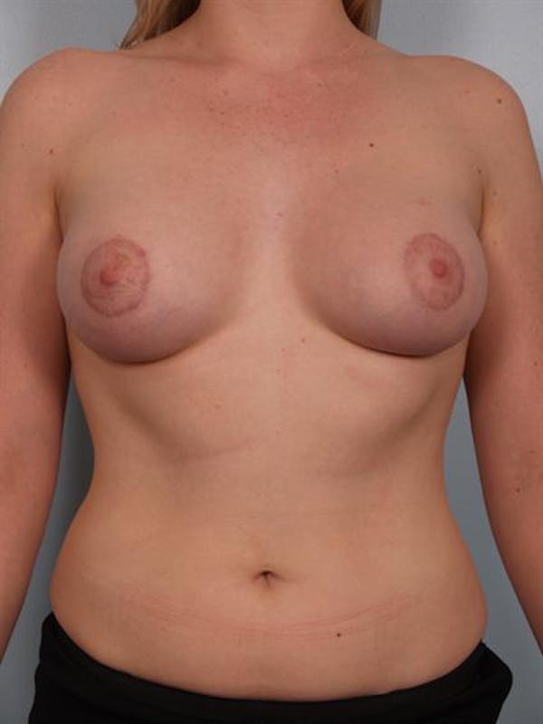 Breast Lift Gallery - Patient 1311080 - Image 2