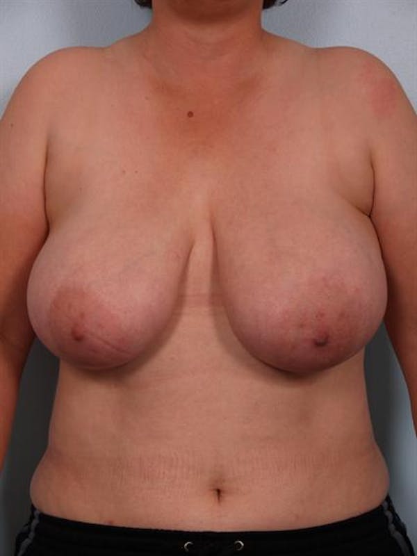 Power Assisted Liposuction Before & After Gallery - Patient 1311078 - Image 5