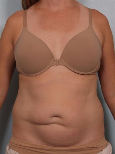 Tummy Tuck Before & After Gallery - Patient 1311082 - Image 1