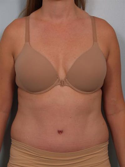 Tummy Tuck Before & After Gallery - Patient 1311082 - Image 2