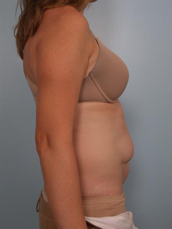 Tummy Tuck Before & After Gallery - Patient 1311082 - Image 3