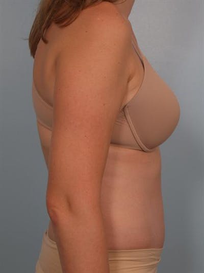 Tummy Tuck Before & After Gallery - Patient 1311082 - Image 4