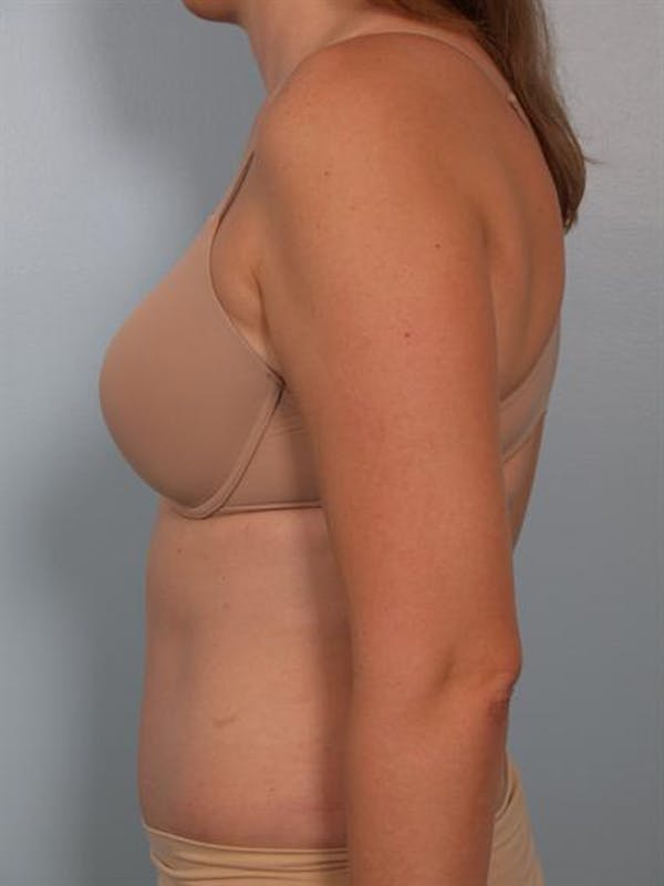 Tummy Tuck Before & After Gallery - Patient 1311082 - Image 6