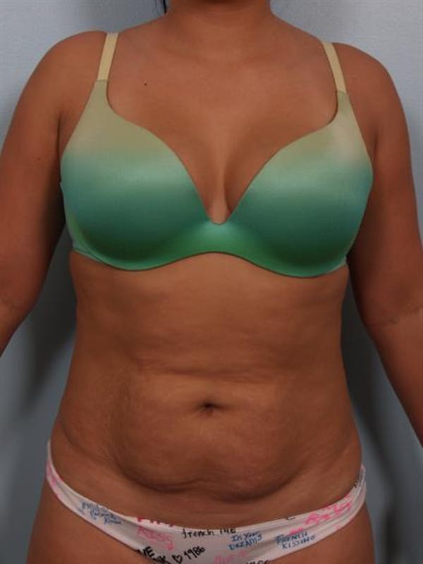 Power Assisted Liposuction Before & After Gallery - Patient 1311084 - Image 1