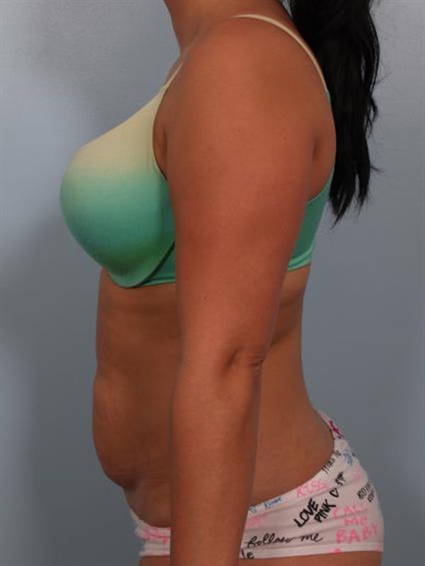 Power Assisted Liposuction Gallery - Patient 1311084 - Image 3