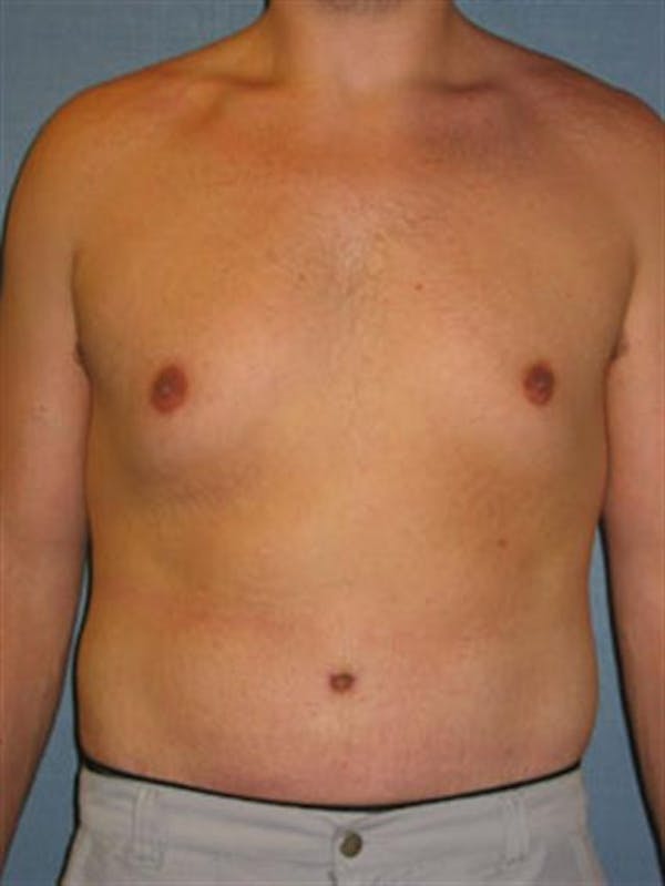 Tummy Tuck Before & After Gallery - Patient 1311085 - Image 2