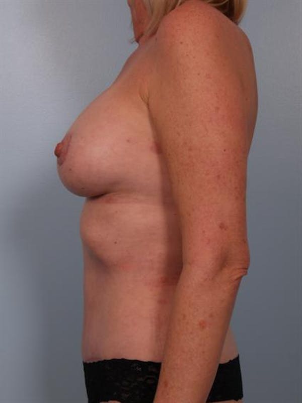 Breast Lift Gallery - Patient 1311086 - Image 4