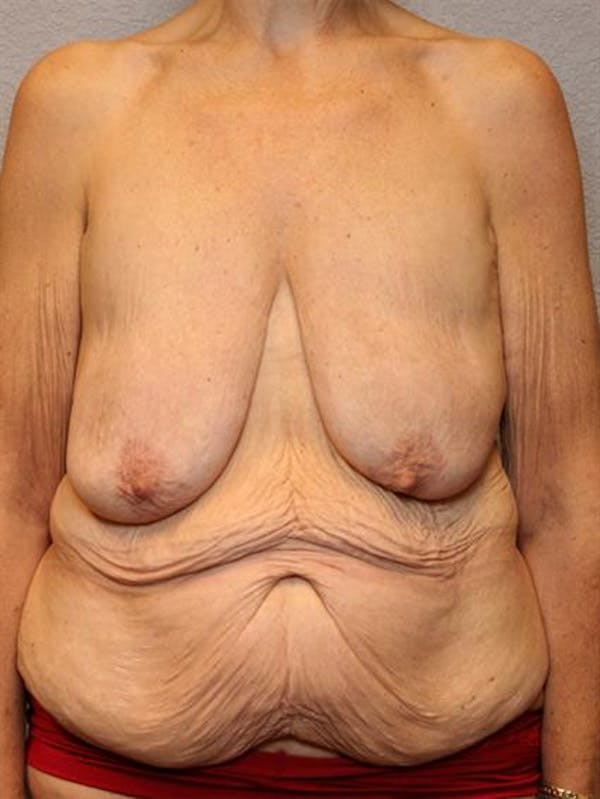Tummy Tuck Before & After Gallery - Patient 1311088 - Image 1