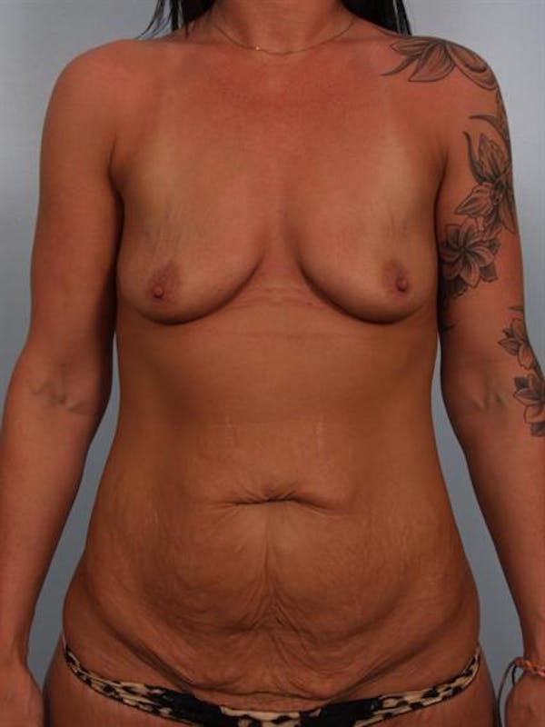 Breast Lift Gallery - Patient 1311090 - Image 1