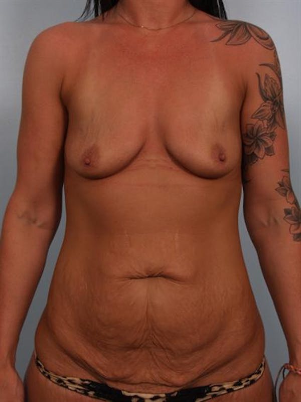 Tummy Tuck Before & After Gallery - Patient 1311092 - Image 1