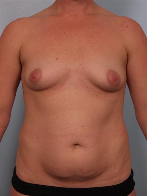 Tummy Tuck Before & After Gallery - Patient 1311097 - Image 3
