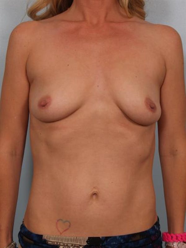 Breast Lift Gallery - Patient 1311098 - Image 1