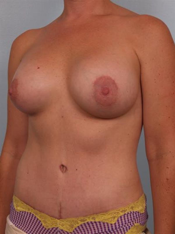Tummy Tuck Before & After Gallery - Patient 1311097 - Image 6
