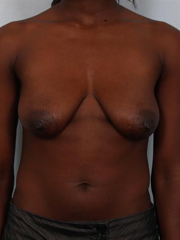 Breast Lift Before & After Gallery - Patient 1311104 - Image 1