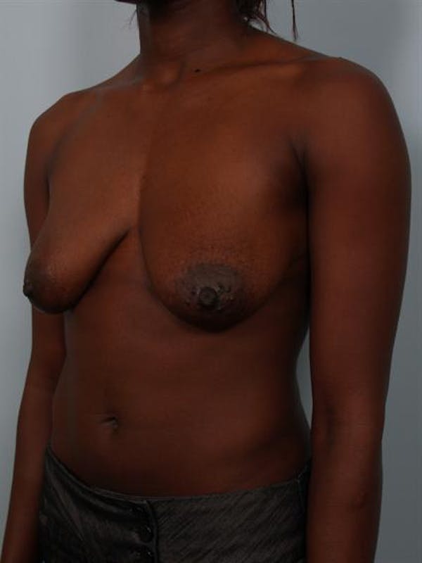 Breast Lift Before & After Gallery - Patient 1311104 - Image 3