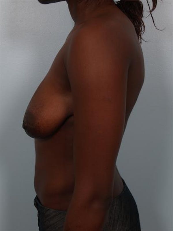 Breast Lift Before & After Gallery - Patient 1311104 - Image 5