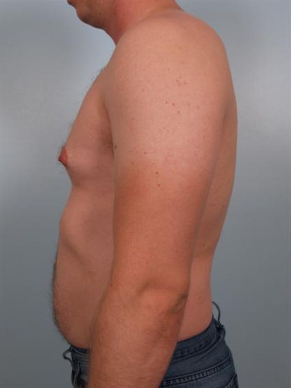 Power Assisted Liposuction Gallery - Patient 1311105 - Image 1