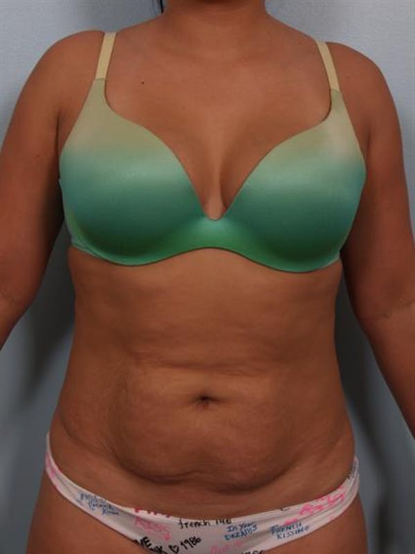 Tummy Tuck Before & After Gallery - Patient 1311106 - Image 1