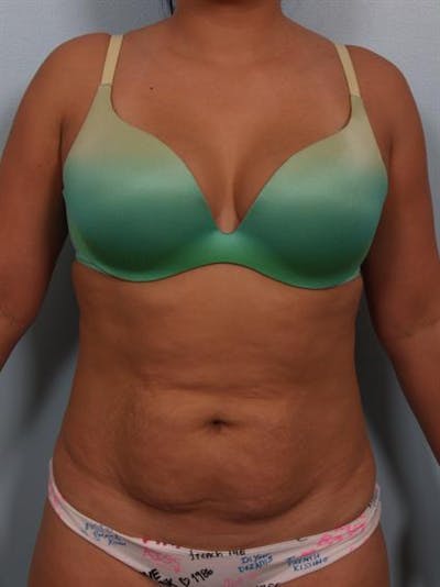Tummy Tuck Gallery - Patient 1311106 - Image 1