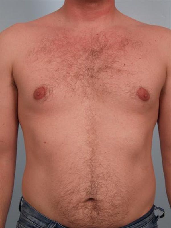 Power Assisted Liposuction Gallery - Patient 1311105 - Image 3