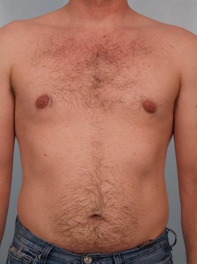 Power Assisted Liposuction Before & After Gallery - Patient 1311105 - Image 4