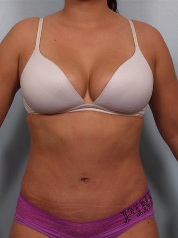 Tummy Tuck Before & After Gallery - Patient 1311106 - Image 2
