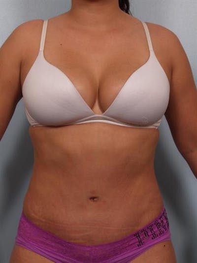 Tummy Tuck Before & After Gallery - Patient 1311106 - Image 2