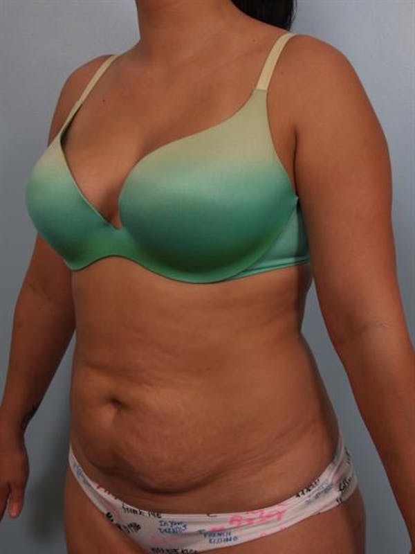 Tummy Tuck Before & After Gallery - Patient 1311106 - Image 5