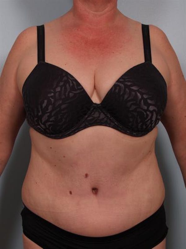 Power Assisted Liposuction Gallery - Patient 1311109 - Image 4
