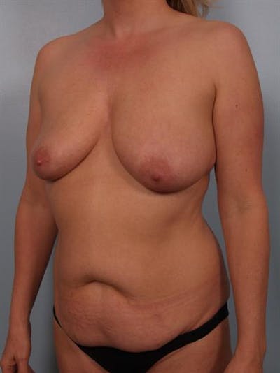 Tummy Tuck Before & After Gallery - Patient 1311110 - Image 1
