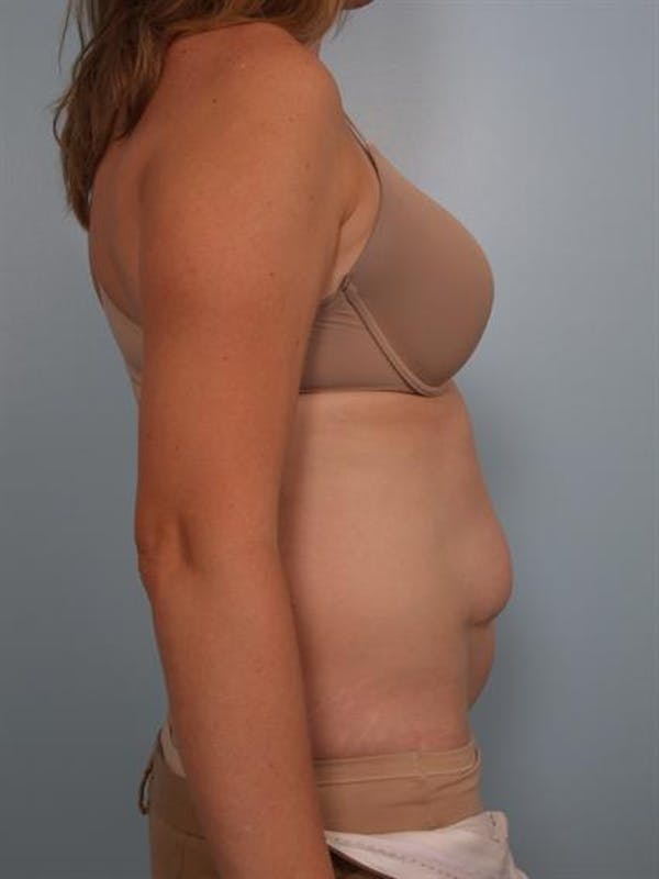 Power Assisted Liposuction Before & After Gallery - Patient 1311115 - Image 3