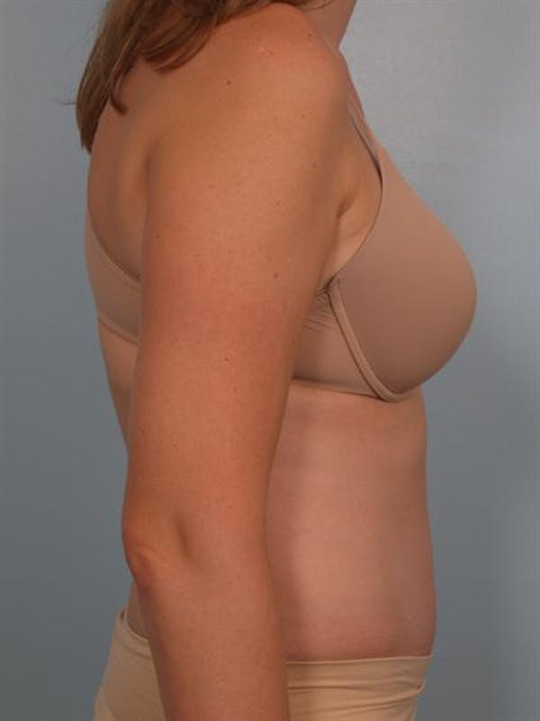 Power Assisted Liposuction Before & After Gallery - Patient 1311115 - Image 4