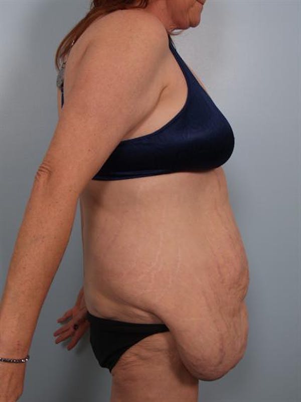 Tummy Tuck Before & After Gallery - Patient 1311116 - Image 1