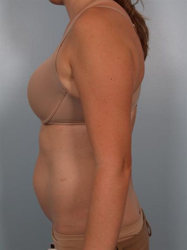 Power Assisted Liposuction Before & After Gallery - Patient 1311115 - Image 5