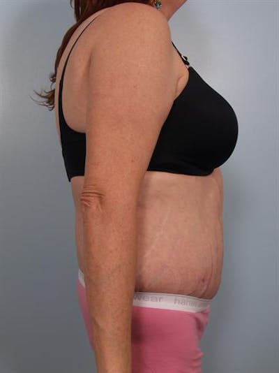 Tummy Tuck Before & After Gallery - Patient 1311116 - Image 2