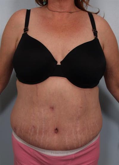 Tummy Tuck Gallery - Patient 1311116 - Image 4